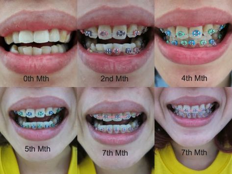 braces colors - Google Search #braces #braces #tips Braces Color Wheel, Braces Food, Braces Smile, Cute Braces Colors, Braces Tips, Getting Braces, Braces Girls, Invisible Braces, Cute Braces