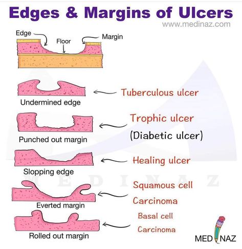 Oral Pathology Notes, Nursing Tools, Wound Care Dressings, Studying Notes, Oral Pathology, Pressure Ulcer, Nurse School, Basal Cell, Vascular Surgery