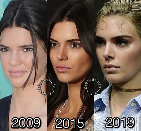 Kendall Jenner Surgery, Kendall Jenner Kylie Jenner, Get Taller Exercises, Celebrity Surgery, Taller Exercises, Get Taller, Celebrities Then And Now, Nose Job, Kendall And Kylie Jenner