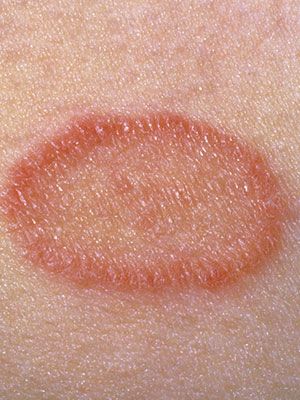 Skin conditions such as ringworm, rosacea, eczema, contact dermatitis, and seborrhea can look red, itch, and even cause pain. Learn how they are treated. Facial Warts, Skin Growths, Natural Acne Remedies, Skin Condition, Perfectly Posh, Acne Remedies, Skin Diseases, Foreign Language, Itchy Skin