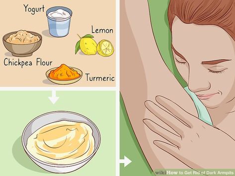 How to Get Rid of Dark Armpits: 12 Steps (with Pictures) - wikiHow Get Rid Of Dark Armpits, Acanthosis Nigricans, Dark Armpits, Underarm Whitening, Underarm Odor, Skin Lightener, Armpit Fat, Dark Underarms, Dinner Meal