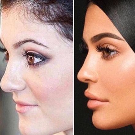 Sergey Voskin MD on Instagram: “Let’s take a look at this side profile of the lovely Kylie Jenner 👀🤩. Can you see the transformation? #COMMENT below 👇👇👇 to let us know…” Celebrities Christmas, Aesthetics Nurse, Jaw Reduction Surgery, Face Plastic Surgery, Nose Surgery Rhinoplasty, Plastic Surgery Fail, Chin Implant, Rhinoplasty Nose Jobs, Hair Implants