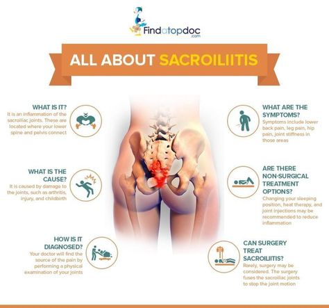 What Is Sacroiliitis: Causes, Symptoms, and Home Remedies Joints In The Body, Nerve Pain Remedies, Lower Back Pain Exercises, Lower Back Pain Relief, Nerve Pain Relief, Sciatic Nerve Pain, Sciatic Nerve, Joints Pain Relief, Leg Pain