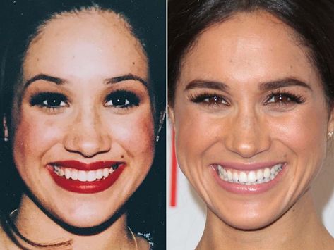 Meghan Markle in the 1990s (left) and in 2014 (right). Meghan Markle Nose Job, Meghan Markle Plastic Surgery, Meghan Markle Hair, Celebrity Surgery, Cheek Implants, Botox Lips, Celebs Without Makeup, Princess Meghan, Natural Glowing Skin