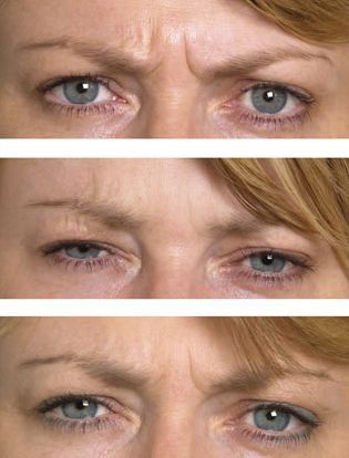 Training The Face In Your Own Home: Correct Nasty Glabellar Furrows For Guys And Women Frown Wrinkles, Yoga For Face, Brow Wrinkles, Worry Lines, Facelift Without Surgery, Growth Hair Oil, Facial Fitness, Botox Brow Lift, Cosmetic Fillers