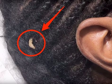 VIDEO: Dr. Pimple Popper found a strange growth on her patient's head - Insider Pimple Inside Nose, Head Pimples, Huge Pimple, Ear Pimple, Pimple Popper Tool, Honey Face Cleanser, Blind Pimple, Diy Facial Mask, Pimples Under The Skin