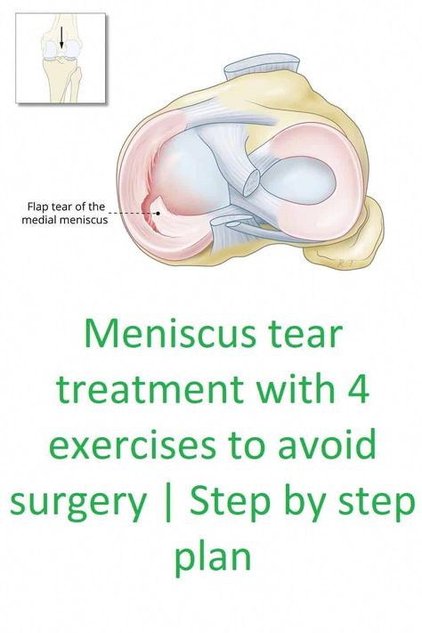 #HerbsForNervePainRelief Meniscus Root Tear Recovery, Torn Medial Meniscus Exercises, Meniscus Exercises, Meniscus Surgery Recovery, Knee Meniscus, Meniscus Surgery, Knee Pain Relief Remedies, Meniscal Tear, Knee Pain Relief Exercises