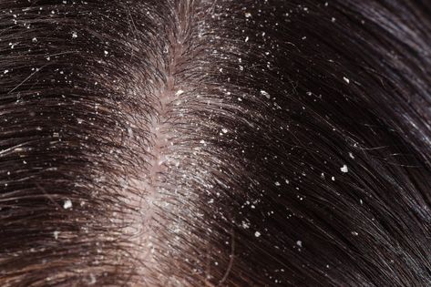 Dandruff on woman's dark hair | Premium Photo #Freepik #photo #people #medical #hair #health Mustard Oil For Hair, Diy Highlights Hair, Severe Dandruff, Coconut Milk For Hair, Olive Oil For Face, How To Treat Dandruff, Home Remedies For Dandruff, Banana Hair Mask, Rid Of Dandruff