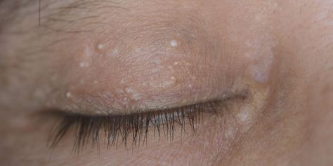 Bump On Eyelid, White Bump On Eyelid, Head Acne, Healthy Skin Care Routine, Laser Surgery, Eye Center, Proper Hygiene, Upper Eyelid, Facial Peel