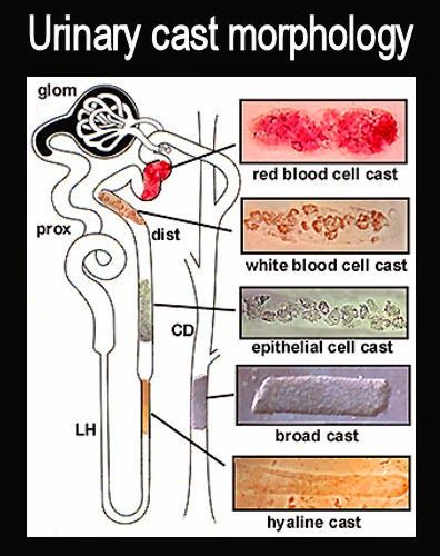 Medical Laboratory and Biomedical Science: Urinary cast morphology Clinical Pathology, Medical Lab Technician, Vet Tech School, Medical Laboratory Technician, Clinical Chemistry, Medical Laboratory Scientist, Laboratory Technician, Medical Lab, Vet Medicine