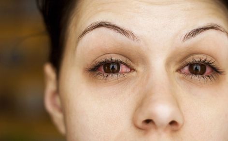 IBD eye problems- Uveitis, Crohn's & ulcerative colitis Bloodshot Eyes, Eye Infections, Pink Eye, Eyes Problems, Eye Drops, Puffy Eyes, Dry Eyes, Pink Eyes, Eye Health