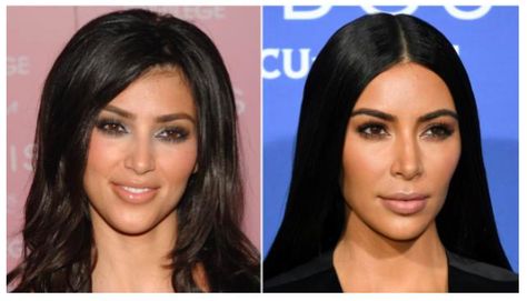 Kardashian hairline houston tx Forehead Hair, Widow's Peak, Cool Sculpting, Hair Transplant, Laser Hair, Laser Hair Removal, Free Hair, Down Hairstyles, Hair Removal