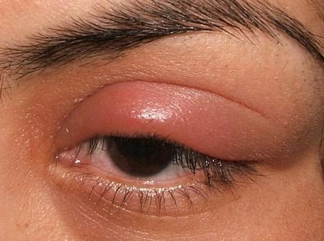 Swollen Eyelids Remedy, Stye Remedy, Swollen Eye, Best Acne Scar Removal, Stye Remedies, Swollen Eyelid, Eye Stye Remedies, Scar Remedies, Cystic Acne Remedies