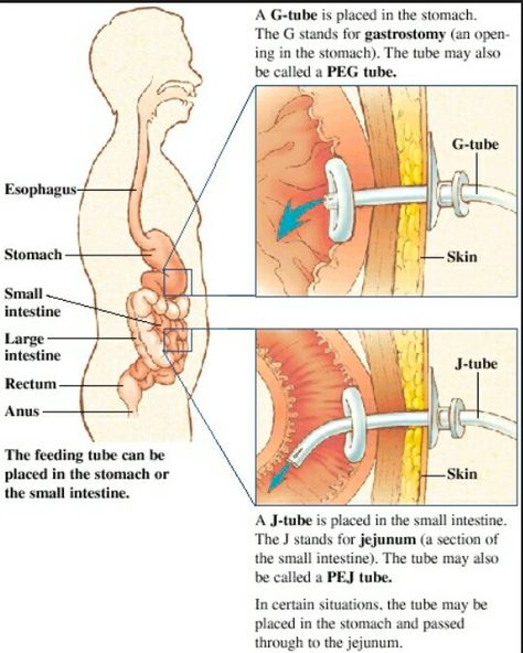 PEG & PEJ Nursing Information, Med Surg Nursing, Child Life Specialist, Nursing, Nursing School Survival, Medical Studies, Nursing School Studying, Nursing School Tips, Nursing School Notes