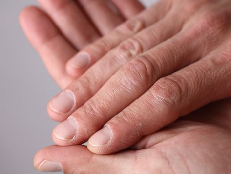 A narrow, vertical black line on your nail is called a splinter hemorrhage. On the other hand, lines that create a horizontal stripe are called Beau's lines. Both conditions that appear as black lines on nails are generally harmless, although they can both signify a more serious underlying condition. Learn more now. Horizontal Ridges In Fingernails, Moons On Fingernails, Nail Ridges, Half Moon Nails, Nail Problems, Dark Red Nails, Makeup Hacks Beauty Secrets, Vitamin Deficiency, Moon Nails