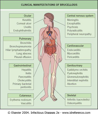 Brucellosis - inflames just about every organ in your body apparently... Community Medicine, Medical Diagrams, Pleural Effusion, Bacterial Diseases, Newborn Schedule, Milk Products, Rangoli Border, Infectious Diseases, Medical Anatomy