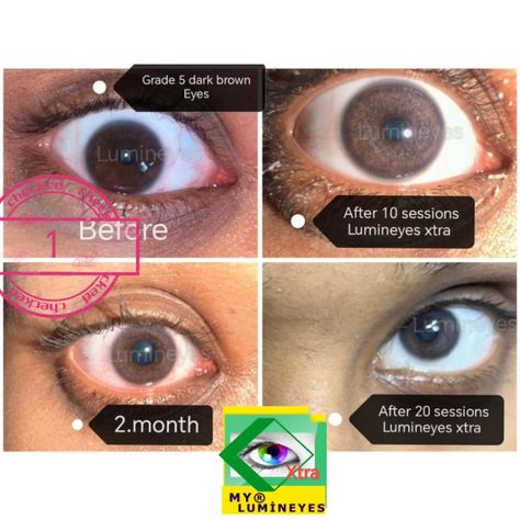 Changing eye color by Lumineyes Xtra laser procedure provides natural and healthy results, even in grade 5 dark brown eyes.... The only non-risky eye color change surgery by laser is "Lumineyes"! https://mylumineyes.com/ #lumineyes #canyouchangeyoureyecolor #drmustafamete #changingeyecolor #changeeyecolor #eyecolors #lasereyecolorchange #mylumineyes Subliminal Eye Color Change Results, Eye Color Change Surgery, White Teeth Tips, Teeth Tips, Woman Eyes, Coordinates Outfits, Laser Eye, Eye Surgery, Dark Brown Eyes