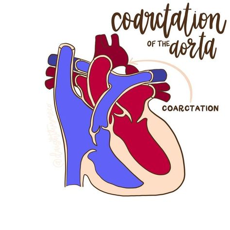 Sarah || Daigh Thyme Co, LLC on Instagram: "If you guessed Coarctation of the Aorta (or coarc) on my story yesterday, you’re correct!! . Coarc is a CHD where the artery leading from the heart (aorta) is narrowed. This forces the heart to have to work harder to get oxygen-rich blood to the rest of the body. . Do you have a coarc warrior in your life?" Heart Transplantation Quotes, Heart Transplantation, Coarctation Of The Aorta, Coronary Bypass Surgery Heart, Spontaneous Coronary Artery Dissection, Chd Awareness, Work Harder, Hard To Get, My Story