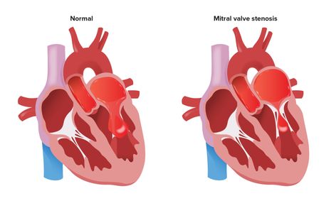 Mitral Stenosis | Concise Medical Knowledge Mitral Stenosis, Mitral Valve Regurgitation, Atrial Septal Defect, Chest Discomfort, Mitral Valve, Spaced Repetition, Heart Sounds, Heart Valves, Atrial Fibrillation