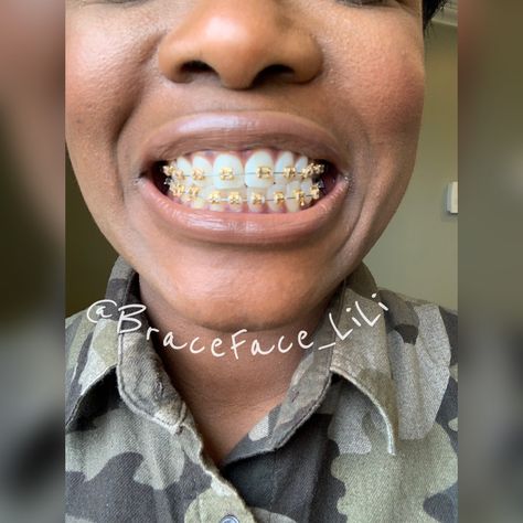 Braces Aesthetic, Braces Journey, Gold Braces, Teeth Gems, Cute Braces Colors, Braces Tips, Getting Braces, Cute Braces, Brace Face