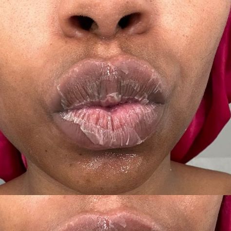 ATLANTA ESTHETICIAN PAUL CHARETTE on Instagram: "SWIPE FOR LIP PEEL RESULTS. 🔥👉👉👉 @CharetteCosmetics is now offering lip peels to get rid of unwanted hyperpigmentation & discoloration! 1️⃣ The first slide shows her peeling on Day 3. 2️⃣ The second slid shows the peel application. 3️⃣ The third slide shows the final result by @aestheticianbae! @aestheticianbae helped her patient get rid of some discoloration on her lips with our Level One Peel. 💰 Pricing starts at $450 🗓 Process lasts 7-2 Viral Lip Peel Off Mask, Lip Peel Off Mask, Peel Off Lip Mask, Lips Peeling, Blood Sugar Diet, Peel Off Mask, Chemical Peel, Lip Mask, Esthetician