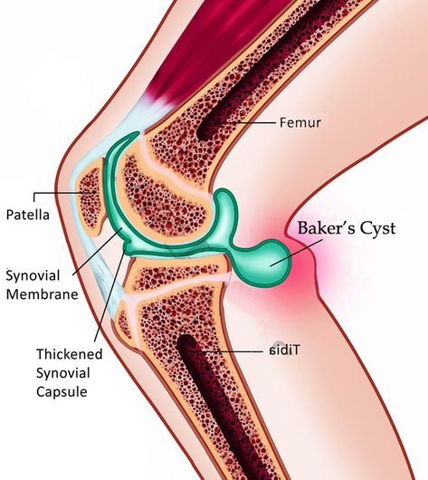 Bursitis Knee, Joints Anatomy, Human Knee, Swollen Knee, Kt Tape, Knee Pain Exercises, Basic Anatomy And Physiology, Human Body Anatomy, Muscle Anatomy