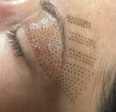 Elmira Studio - Plasma Pen Treatments Westlake Village, CA Plasma Facial, Fibroblast Plasma, Remove Skin Tags Naturally, Plasma Pen, Skin Needling, Face Lift Surgery, Skin Tightening Treatments, Skin Tightening Face, Skin Aesthetics