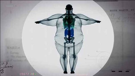 This image of an apparent X-ray of a 70-stone (980-pound) man has gone viral after trending heavily on Twitter . | This Is What A 980-Pound Man Looks Like On The Inside Big Boned, Respiratory Therapy, Pisco, X Ray, Plastic Surgery, Take Care Of Yourself, Radios, Pilates, A Man