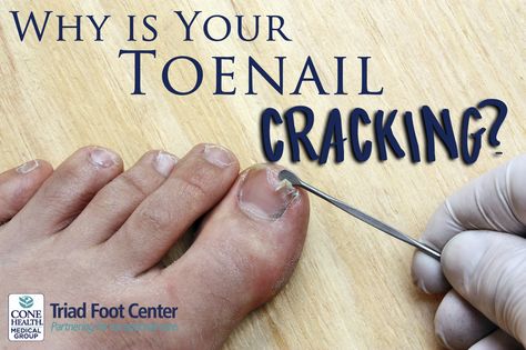 Split Nail Repair, Broken Toenail, Split Toenail, Brittle Toenails, Stye Remedies, Eye Stye Remedies, Growing Grape Vines, Natural Antifungal, Nail Remedies