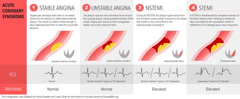 Stemi Vs Nstemi, Pediatric Cardiac Nursing Congenital Heart Defect, Percutaneous Coronary, Acute Coronary Syndrome Nursing, Cath Lab Nursing, Cardiac Arrhythmias Nursing, Pathophysiology Nursing, Coronary Arteries Disease Nursing, Acute Coronary Syndrome