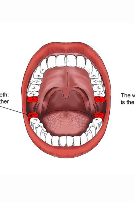 #1: Irritation in the Gums – You may feel slight irritation and notice swelling in the gums in the area behind the second molars. #2: Aches and Pains – Wisdom teeth growth often causes a dull ache near the back of the jaw that for some people can turn into frequent, more pronounced pain. #3: Pain in Other Areas – Wisdom teeth sometimes put pressure on nerves in a way that causes pain around the jaw, eyes and ears. Eat After Wisdom Teeth Removal, How To Prepare For Wisdom Teeth Removal, Wisdom Teeth Recovery, Wisdom Teeth Pain, Red Snacks, South Loop Chicago, Wisdom Tooth Extraction, Oral Maxillofacial, Wisdom Teeth Removal