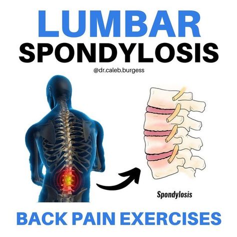 Dr. Caleb Burgess DPT OCS CSCS on Instagram: "💥Lumbar Spondylosis💥 📚 Lumbar spondylosis is a generalized term used to describe any and all degenerative conditions affecting the discs, vertebral bodies, and/or associated joints of the lumbar spine 🧓🏼 So basically, as your spine begins to show signs of aging, it could be described as lumbar "spondylosis" 🤯 In fact, over 80% of people over the age of 40 have lumbar spondylosis ➡️ This can be asymptomatic (without symptoms) or symptomatic (wit Lumber Spondylosis Exercise, Spondylosis Lumbar, Lumbar Spondylosis, Nose Picking, Lumbar Spine, Pelvic Tilt, Hip Flexor Stretch, Hamstring Stretch, Back Pain Exercises