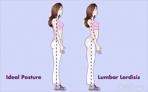 Cervical Lordosis, Lumbar Lordosis, Neck Posture, Rare Disease Awareness, Thoracic Vertebrae, Back Ache, Forward Head Posture, Body Alignment, Pilates Moves