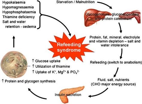 Fasting and re-feeding syndrome - Diet Doctor Refeeding Syndrome, Deficiency Diseases, Cardiac Rhythms, Clinical Nutrition, Fluid And Electrolytes, Diet Doctor, Energy Sources, Nursing Students, Literature