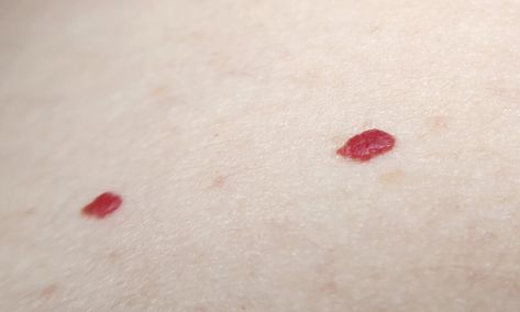 If You Spot These Red Dots On Your Skin, You Had Better Know What They Mean How To Get Rid Of Red Spots On Face, Red Moles On Skin, Red Dots On Skin, Red Bumps On Face, Red Spots On Skin, Red Spots On Face, Bumps On Legs, Red Skin Spots, Red Moles