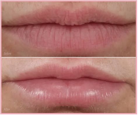 Vertical lip lines are notorious for giving away a person’s age. What’s more, everyday solutions to cover them up just don’t work. There are better nonsurgical solutions (this lip before and after is just one!) #botox #cosmeticinjectables #dermalfillers #fillers #injectables #PlateletRichPlasma #PRP Smoker Lines Before And After, Lip Filler For Smoker Lines, Lip Fillers Before And After, Lip Line Filler, Best Lip Plumping Gloss, Upper Lip Wrinkles, Smokers Lines, Reverse Aging Skin, Botox Before And After