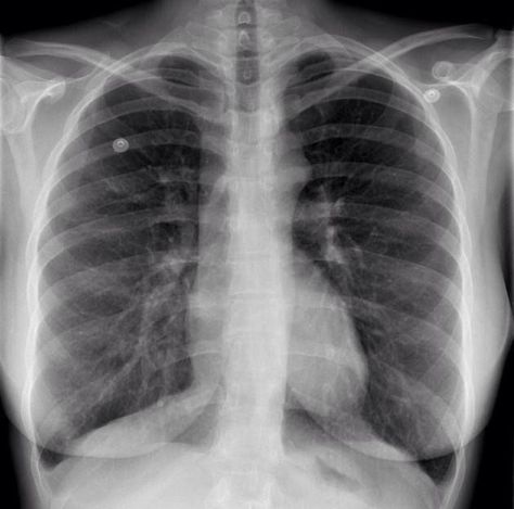 Coarctation Of The Aorta, Subclavian Artery, Hospital Admit, Black Poets, Xray Art, X-ray Images, Hospital Admit Hand Pics, Body Ache, Radiology