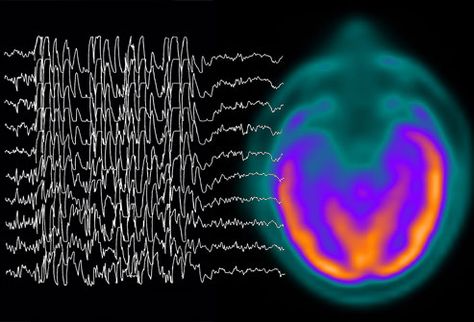 Epilepsy Pictures: Seizures, Symptoms, Tests, Treatments, and More Status Epilepticus, Absence Seizures, Types Of Seizures, Impulse Control, Brain Scan, Nerve Cell, Neurological Disorders, Alternative Treatments, Brain Waves