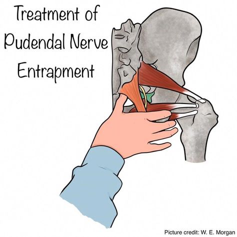 Pudendal Nerve Pain Relief, Pudendal Neuralgia, Pudendal Nerve, Jaw Pain Relief, How To Help Nausea, Referred Pain, The Therapist, Pelvic Floor Dysfunction, Jaw Pain