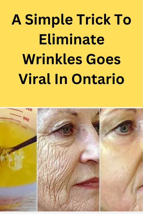 Rid Wrinkles, Wrinkles Remedies Face, Wrinkle Remedies, Wrinkle Free Skin, Eliminate Wrinkles, Skin Care Wrinkles, Natural Anti Aging, Face Wrinkles, Wrinkled Skin