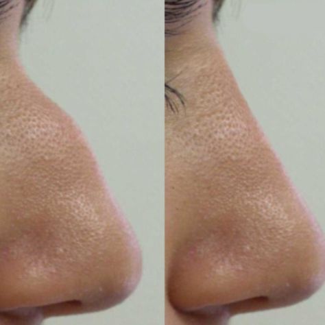 nose-filler Non Surgical Rhinoplasty, Nose Filler, Nose Fillers, Nose Job, Nose Bridge, The Shape, Bump, Girly Things, Surgery