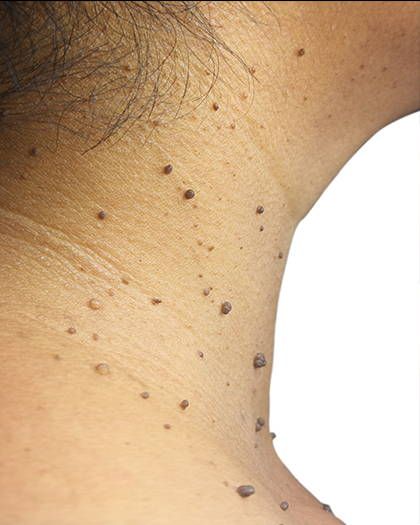 Fast Flat Warts, Remove Skin Tags Naturally, Newborn Feeding, Get Rid Of Warts, Skin Tags, Beauty Clinic, Skin Issues, Oils For Skin, Skin Conditions