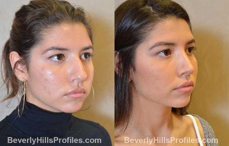 Perfect Nose Rhinoplasty, Nostril Reduction, Job References, Nose Rhinoplasty, Jaw Reduction Surgery, Nose Surgery Rhinoplasty, Plastic Surgery Fail, Nose Jobs, Rhinoplasty Nose Jobs