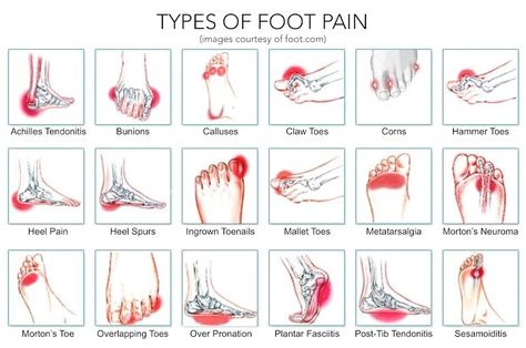 “Your toe bone is connected to your heel bone, your heel bone is connected to your leg bone, your leg bone is connected to your thigh bone …”, maybe you’ll remember how the song goes. I never really paid attention to it, but now I think it does teach a really important thing: that all our bones are connected … Foot Pain Chart, Foot Pain Relief, Juicing For Health, Joints Pain Relief, Preventative Health, Heel Pain, Foot Health, Nerve Pain, Foot Pain