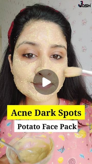 81K views · 1.5K likes | Shalini ♥️ Skin & Hair care 💁‍♀️ on Instagram: "🤗TRY THIS (ACNE PIMPLES DARK SPOTS ) Removal FACE PACK 🙃   Ingridents ✅  Potato paste Fuller's earth Lemon juice ( completely optional) Aloeveragel   Use 2 to 3 times a week for best results ✅   Follow for more ♥️ 💓  . . #acnemarks #pimplemarks #pigmentation #darkspots #skinwhitening #facepack #reels #instagramreels #trending #viralreels #fyp #explorepage" How To Remove Acne From Face, Face Pack For Acne, Remove Acne Marks On Face, Face Dark Spot Remover, Potato For Dark Spots, Remove Pigmentation From Face, Pimples On Face Removal, Potato Juice For Face, Dark Spots Removal