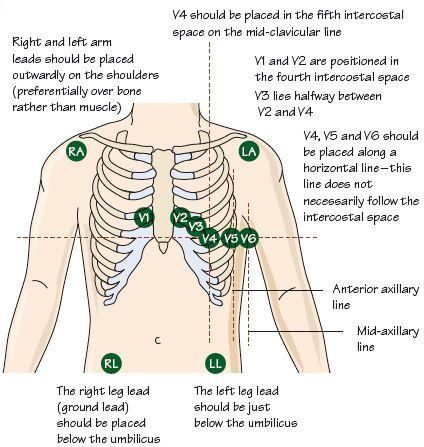 12 leads ekg placement 12 Lead Ekg Placement Cheat Sheets, 12 Lead Ekg Placement Nursing Students, Telemetry Lead Placement, Ekg Leads Placement, 12 Lead Ekg Cheat Sheet, Ecg Lead Placement, Ekg Placement 12 Lead, Ekg Lead Placement, 12 Lead Ekg Placement