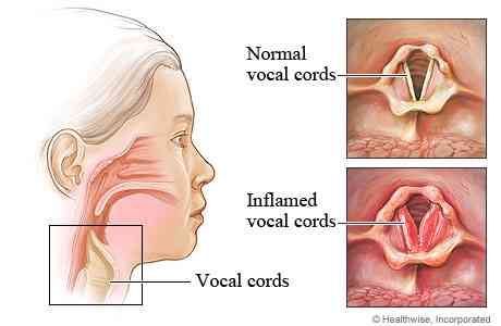 How to get your voice back after losing it. Do the home remedies work? Does drinking tea work? Find out how those myth's are wrong! Remedy For Lost Voice, Lost Voice, Top 10 Home Remedies, Home Health Remedies, Homemade Remedies, Natural Home Remedies, Health Info, Natural Treatments, Natural Medicine