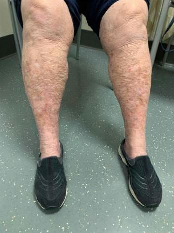 Medication for venous insufficiency: Are they Useful? Fibromuscular Dysplasia, Peripheral Artery, Vein Thrombosis, Venous Insufficiency, Swollen Legs, Leg Pain, Healthcare Professionals, Medical, Health