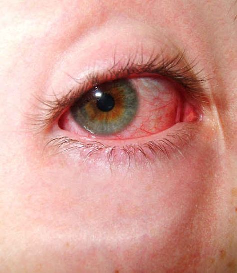 You shouldn't sleep in your contacts. Hey look, no judgment — I do, too, sometimes. Red Eyes Remedy, Natural Pink Eye Remedy, Earache Remedies, Pinkeye Remedies, Dry Eyes Causes, Eye Photography, Aesthetic Eyes, Natural Health Remedies, Pink Eyes