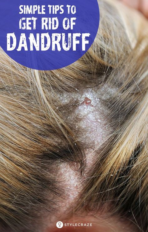 Get Rid Of Dandruff Permanently, Child Hairstyles, Treat Dandruff, Hair Mask For Dandruff, Home Remedies For Dandruff, Rid Of Dandruff, Dandruff Hair, Dandruff Remedy, Types Of Manicures